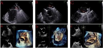 Management of complications associated with percutaneous left atrial appendage closure with or without ablation: experience from 512 cases over a 4-year period